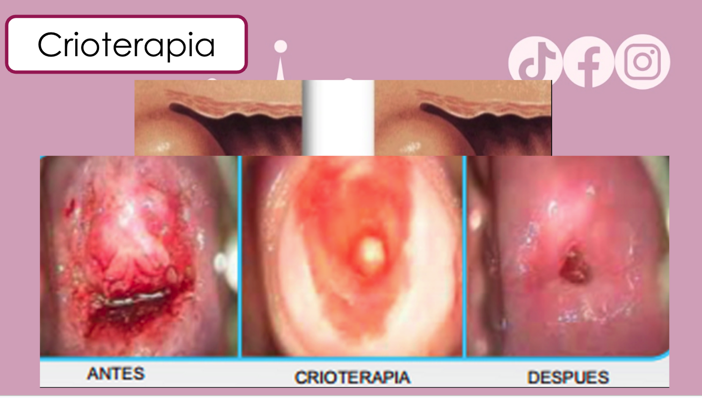 Taller: Juntas contra el VPH