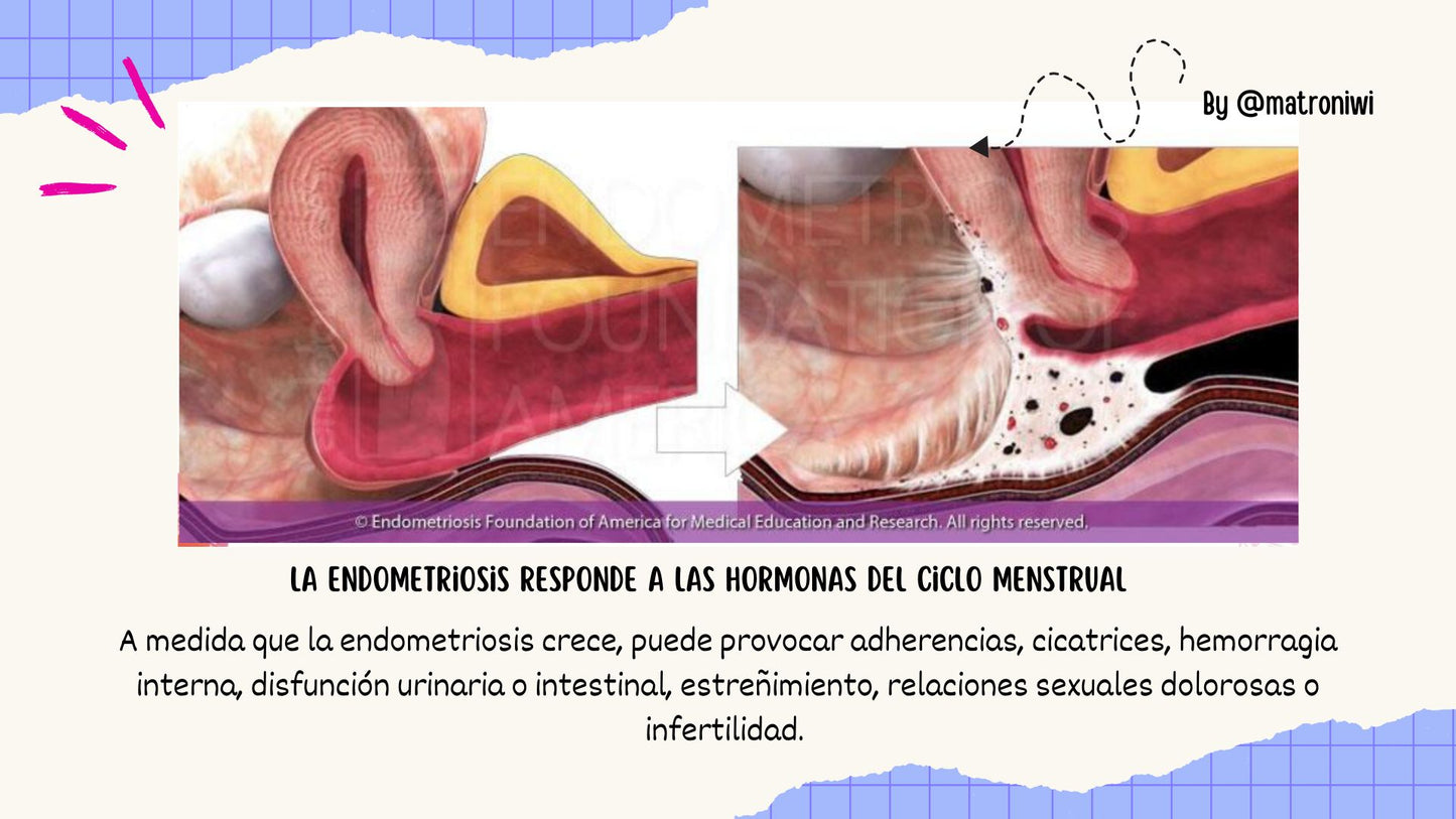 Taller: Endometriosis, explicada pa' la pipol