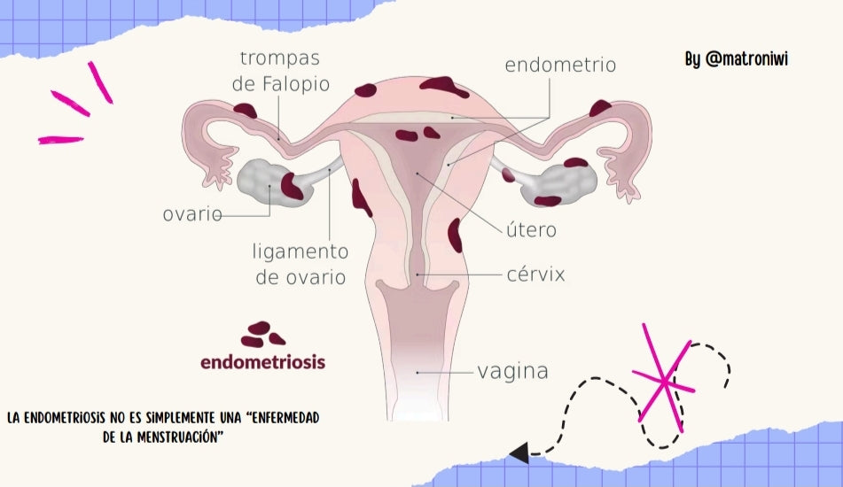 Taller: Endometriosis, explicada pa' la pipol