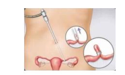 Taller: Pros y contras de la esterilización